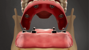 Implant Supported Denture