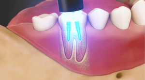 Post and Core Restoration