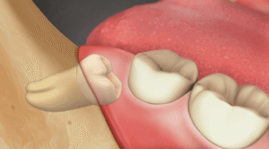 Surgical Wisdom Tooth Extraction (Third Molar)