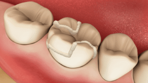 Dental Onlay/Overlay Procedure for Restoring Large Cavities