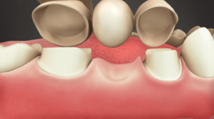 Bridge Replacing Missing Tooth
