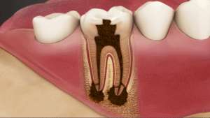 Root Canal Therapy