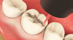 Laser Cavity Treatment and Filling (No-Drill Dentistry)
