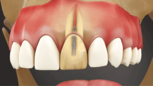 Zirconia Dental Crown Placement Procedure