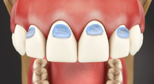Cosmetic Fillings