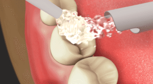 Pit and Fissure Sealants