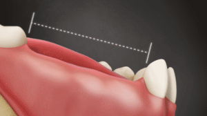 Missing Tooth Options: Bridge vs. RPD vs. Dental Implant Comparison