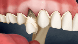 Consequences of Tooth Removal