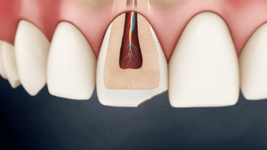 Enamel Fracture and Restoration