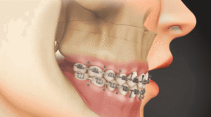 Inter-Maxillary Fixation