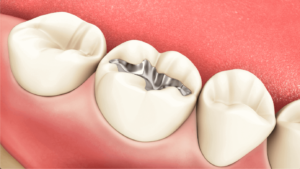 Amalgam Restoration Placement
