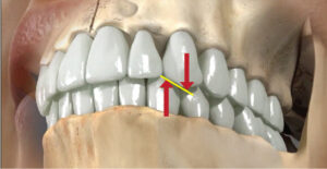 Canine Guided Occlusion